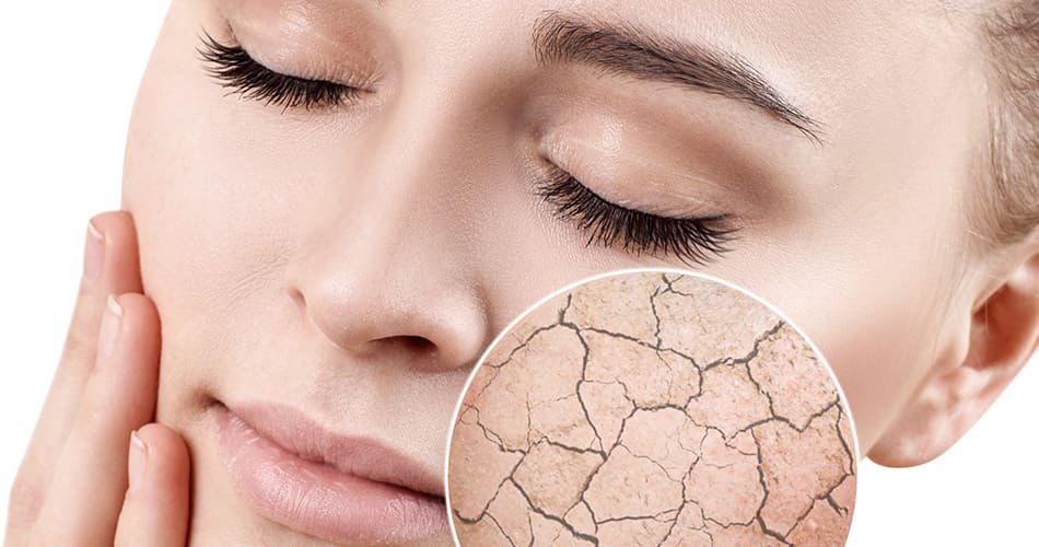 SOS peau sèche ! - Phytoceutic